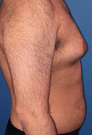 Male Breast Reduction (Gynecomastia Surgery) Before, Male 39 - 2166