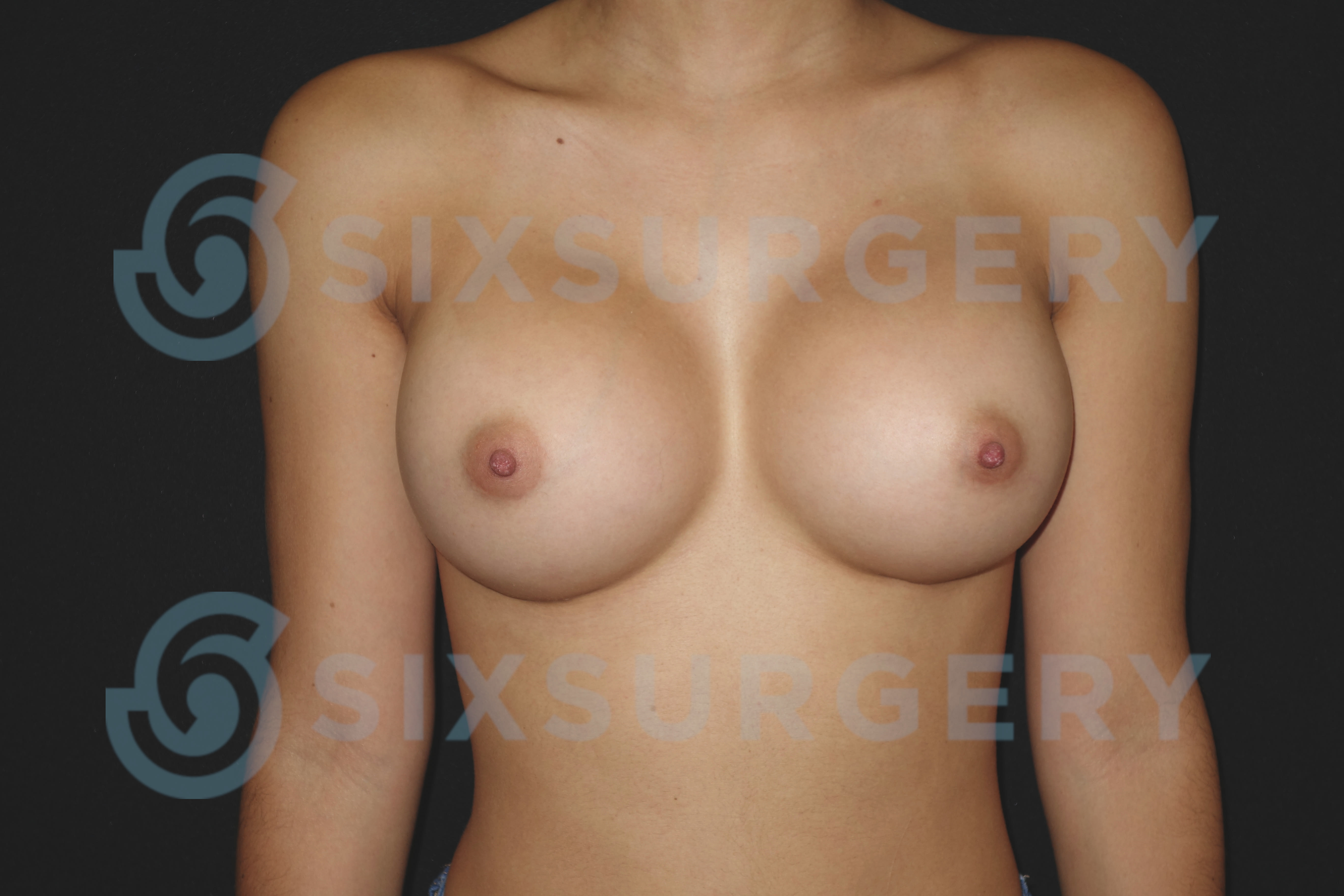Breast Augmentation with Implants After, Female 27 - 1518