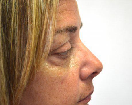 Dermal Filler & Injectable Solutions Before, Female 45 - 1507