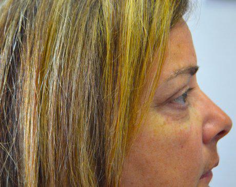 Dermal Filler & Injectable Solutions After, Female 45 - 1507