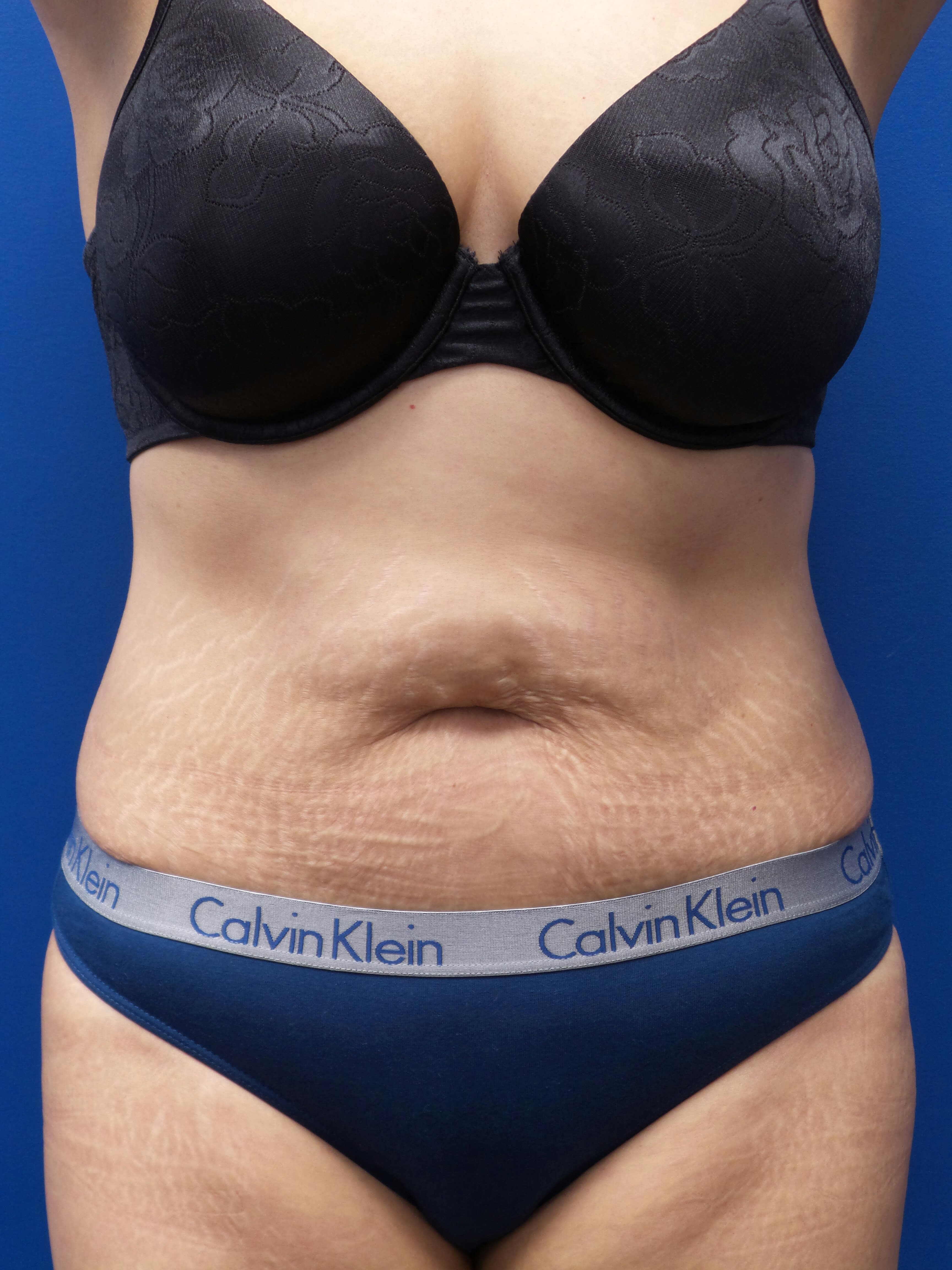 Abdominoplasty Overview Cost Recovery Before After Aedit