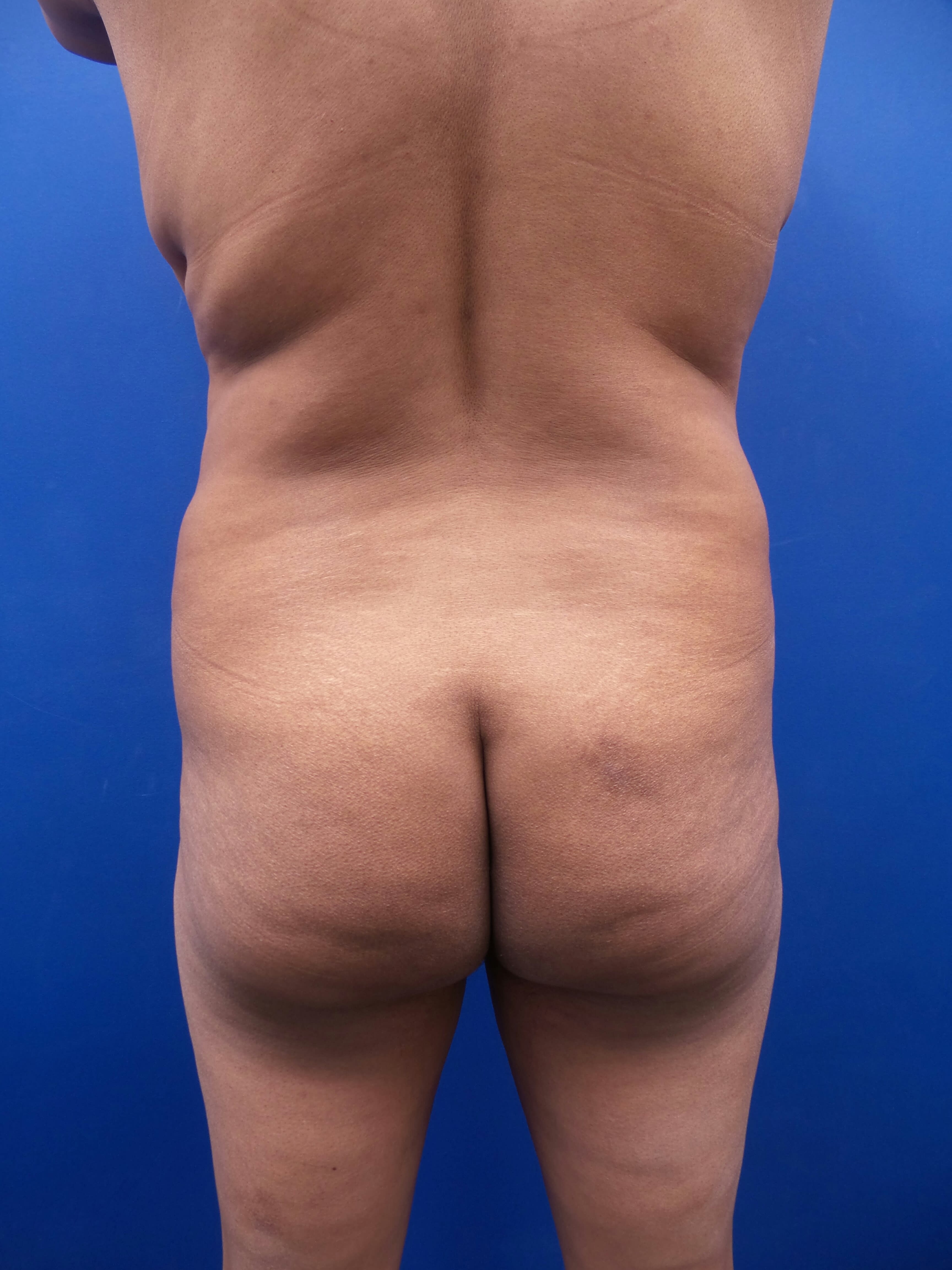 Butt Lift Before, Female 51 - 141