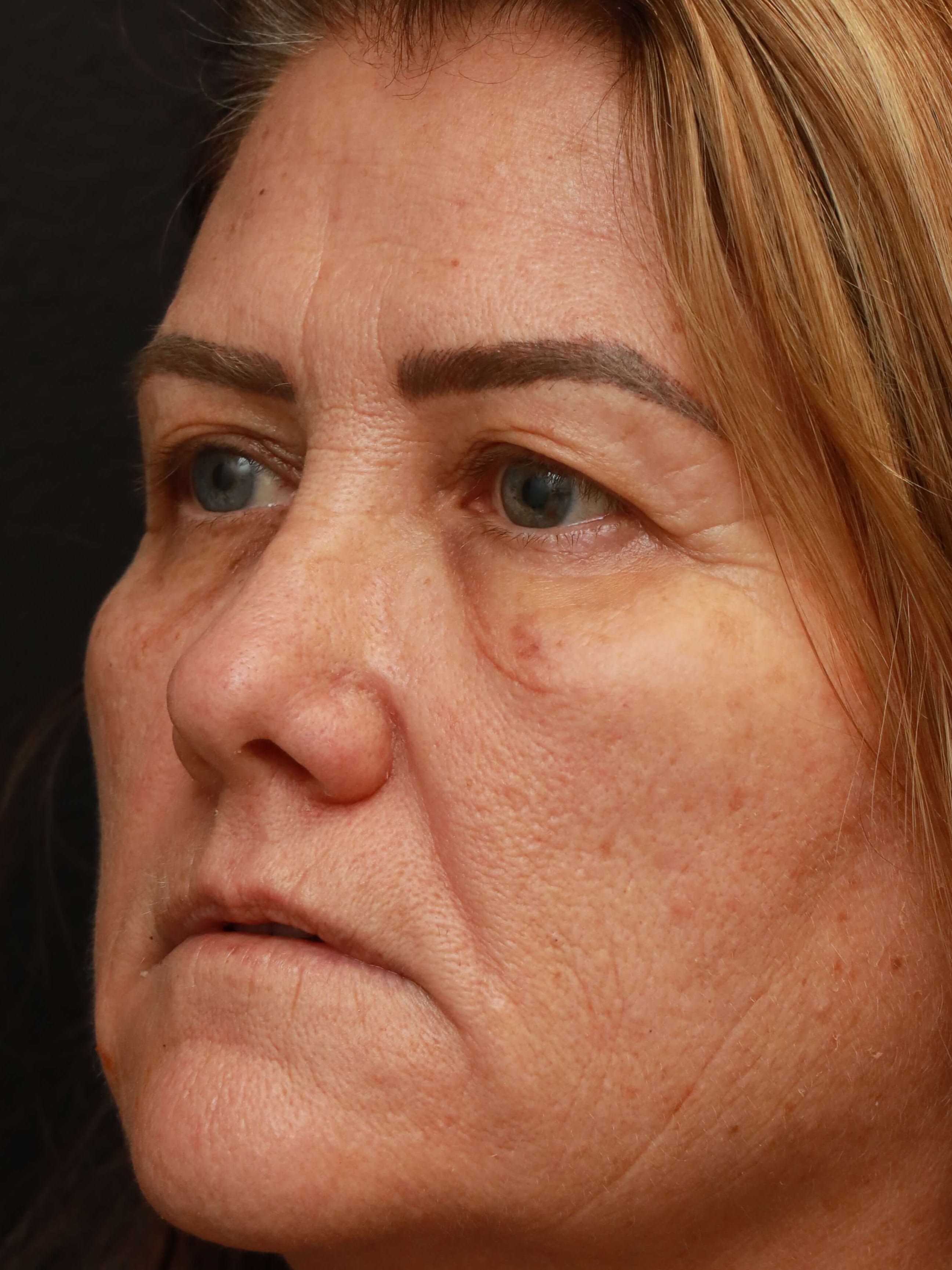 Blepharoplasty Before, Female 58 - 1630