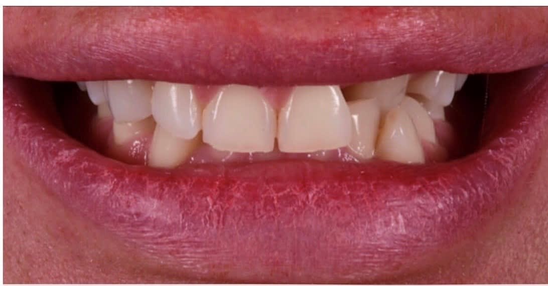 Dental Veneers Before, Female 30 - 181