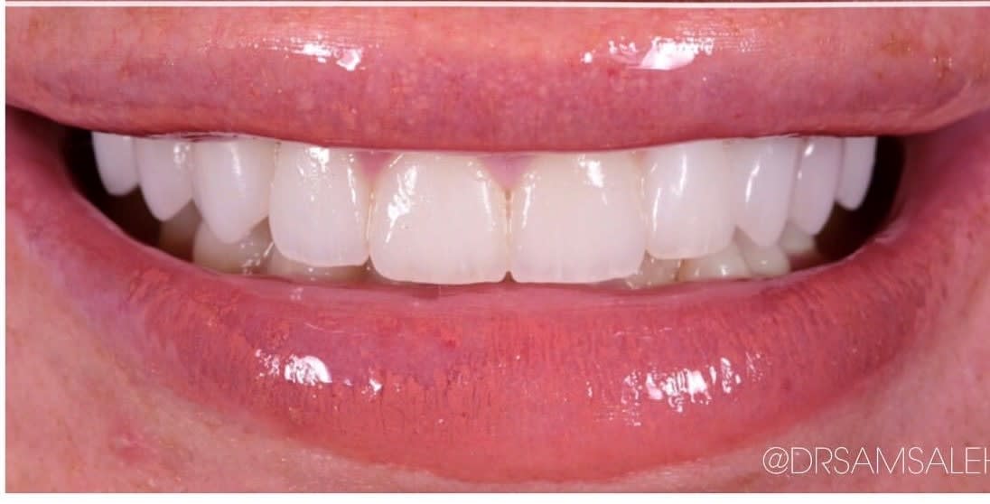 Dental Veneers After, Female 30 - 181