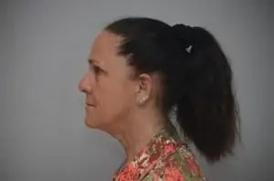 Facelift Before, Female 68 - 4522