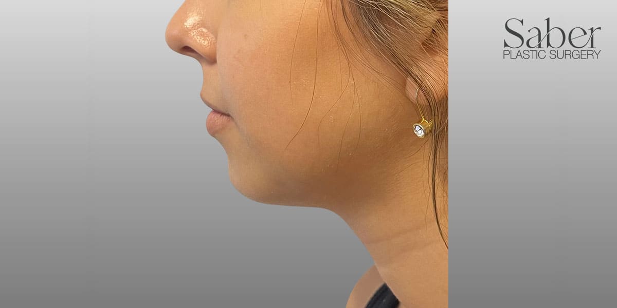 Dermal Fillers & Injectables After, Female 28 - 3935