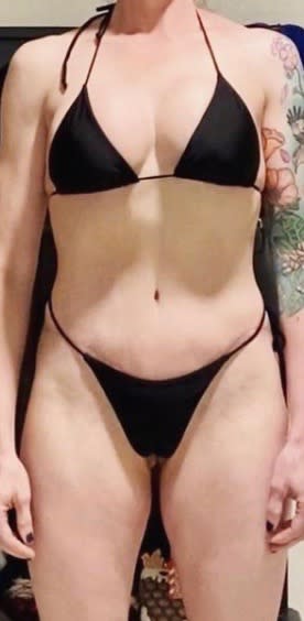 Abdominoplasty After, Female 41 - 2064