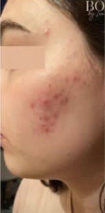 Acne Solutions Before, Female 22 - 1976