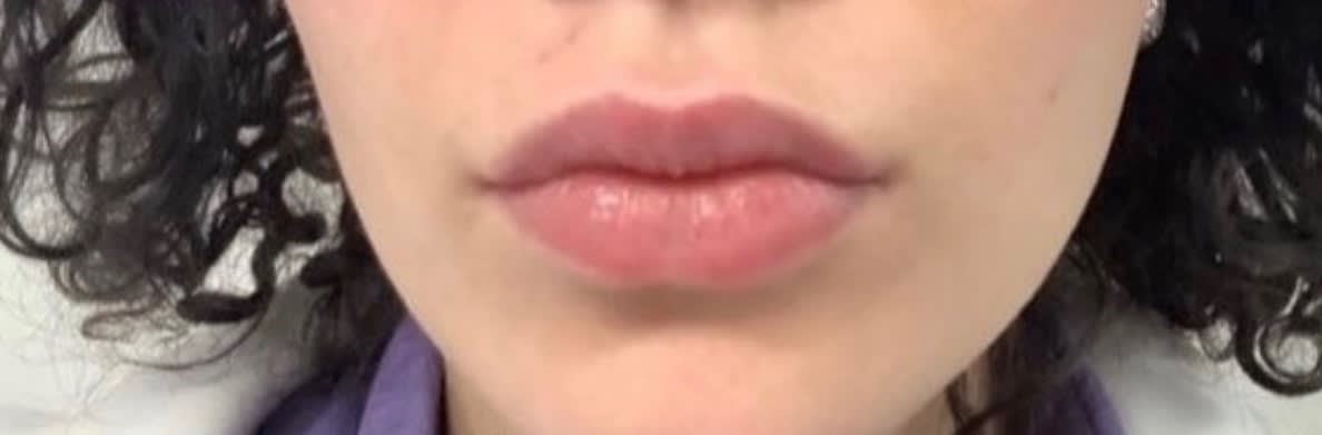 Lip Augmentation and Injections After, Female 22 - 1705