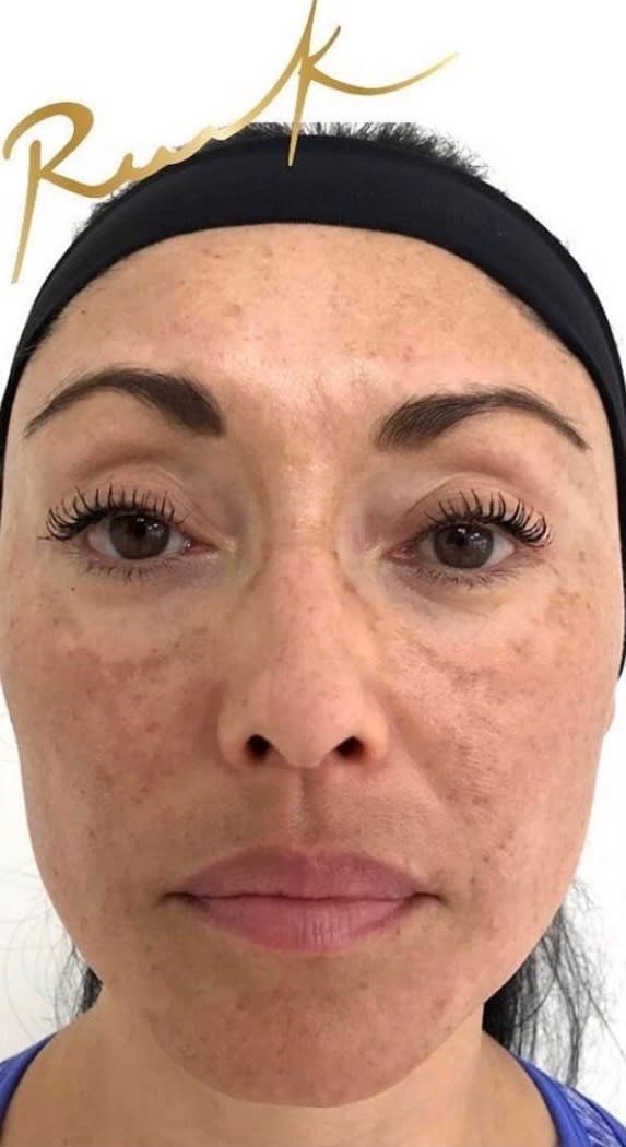Laser Skin Resurfacing Before, Female 36 - 1707