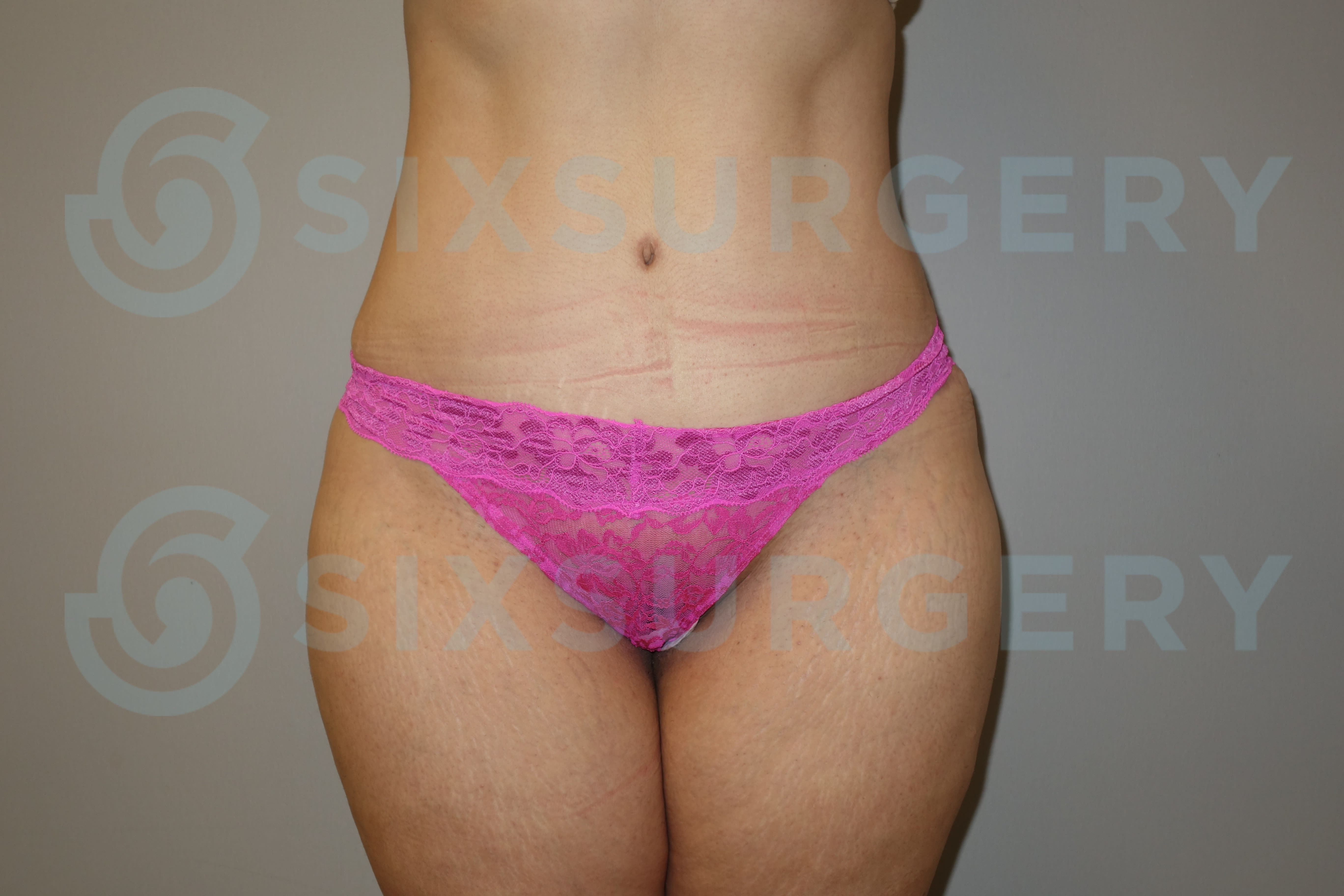 Tummy Tuck (Abdominoplasty) After, Female 36 - 1521