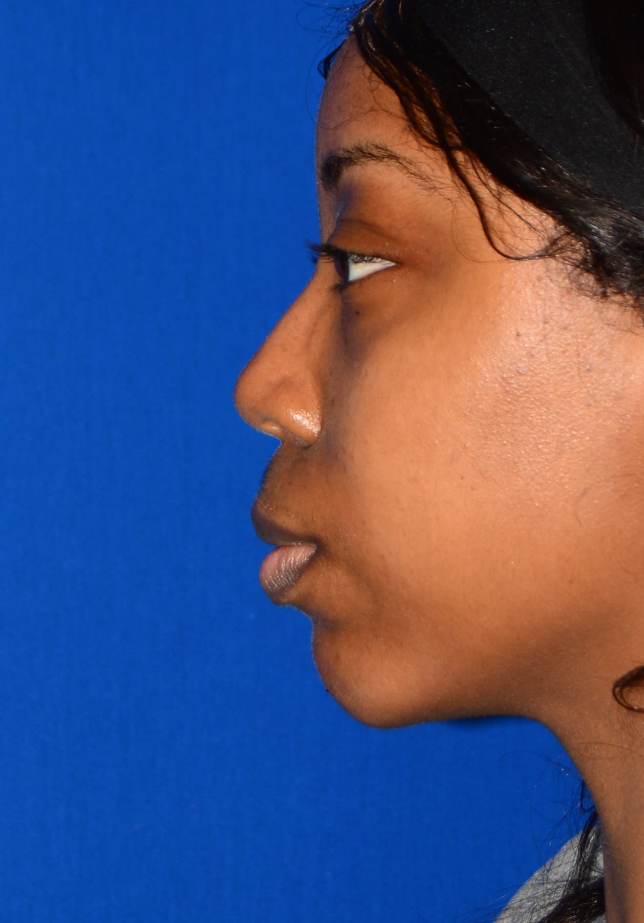 Chin Augmentation After, Female 25 - 1515
