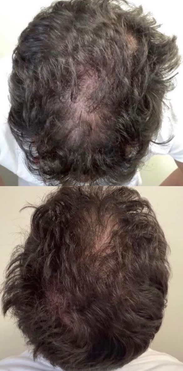 Platelet-Rich Plasma (PRP) Injections for Hair Loss Before, Male 44 - 652