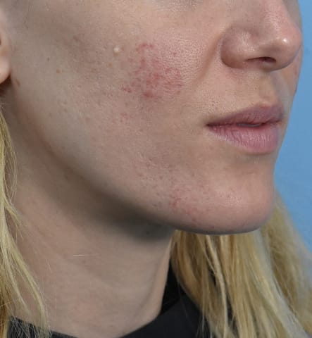 Microneedling with Platelet Rich Plasma (PRP) Before, Female 31 - 502