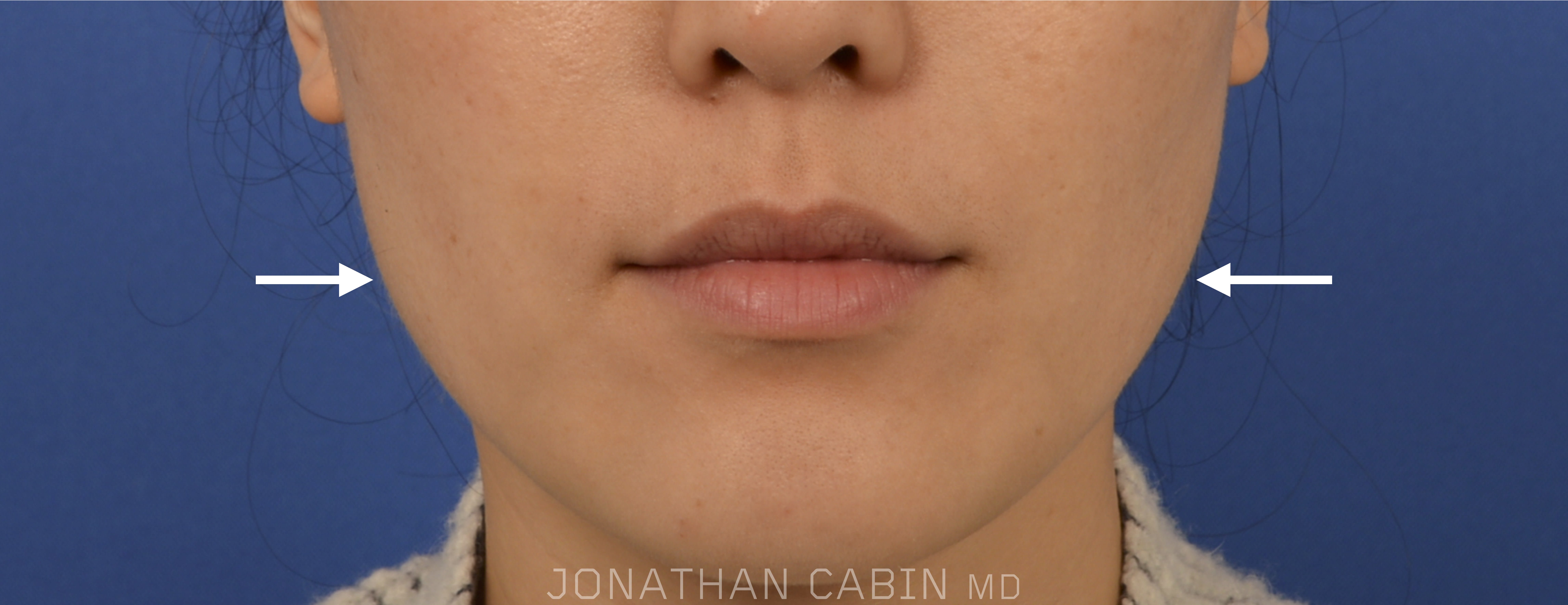 Jawline Slimming With Botox Overview Cost Recovery Before After jawline-slimming-with-botox-overview-cost-recovery-before-after