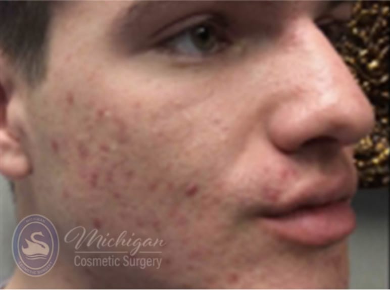 Acne Treatment Before, Male 27 - 4276