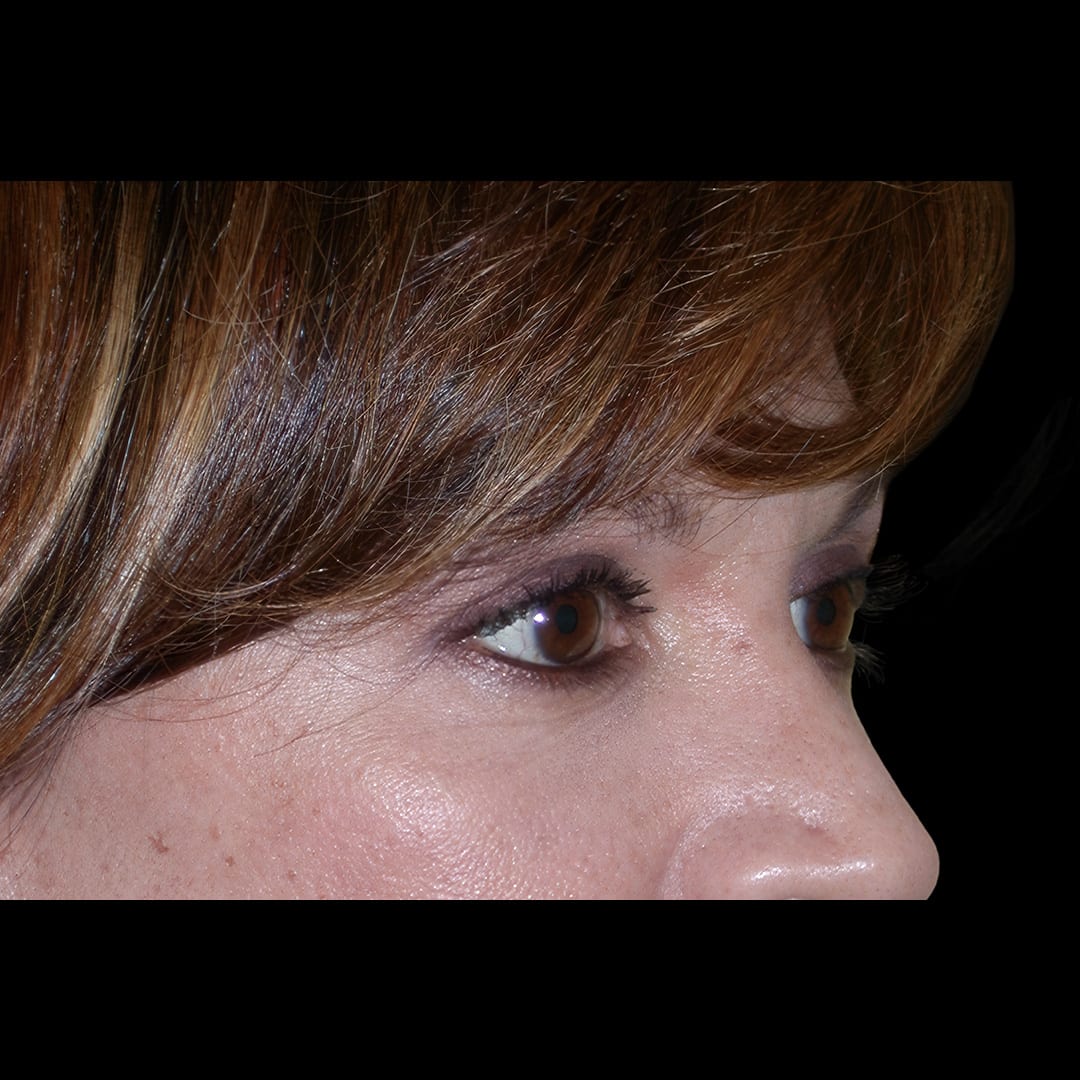 Blepharoplasty After, Female 61 - 4883