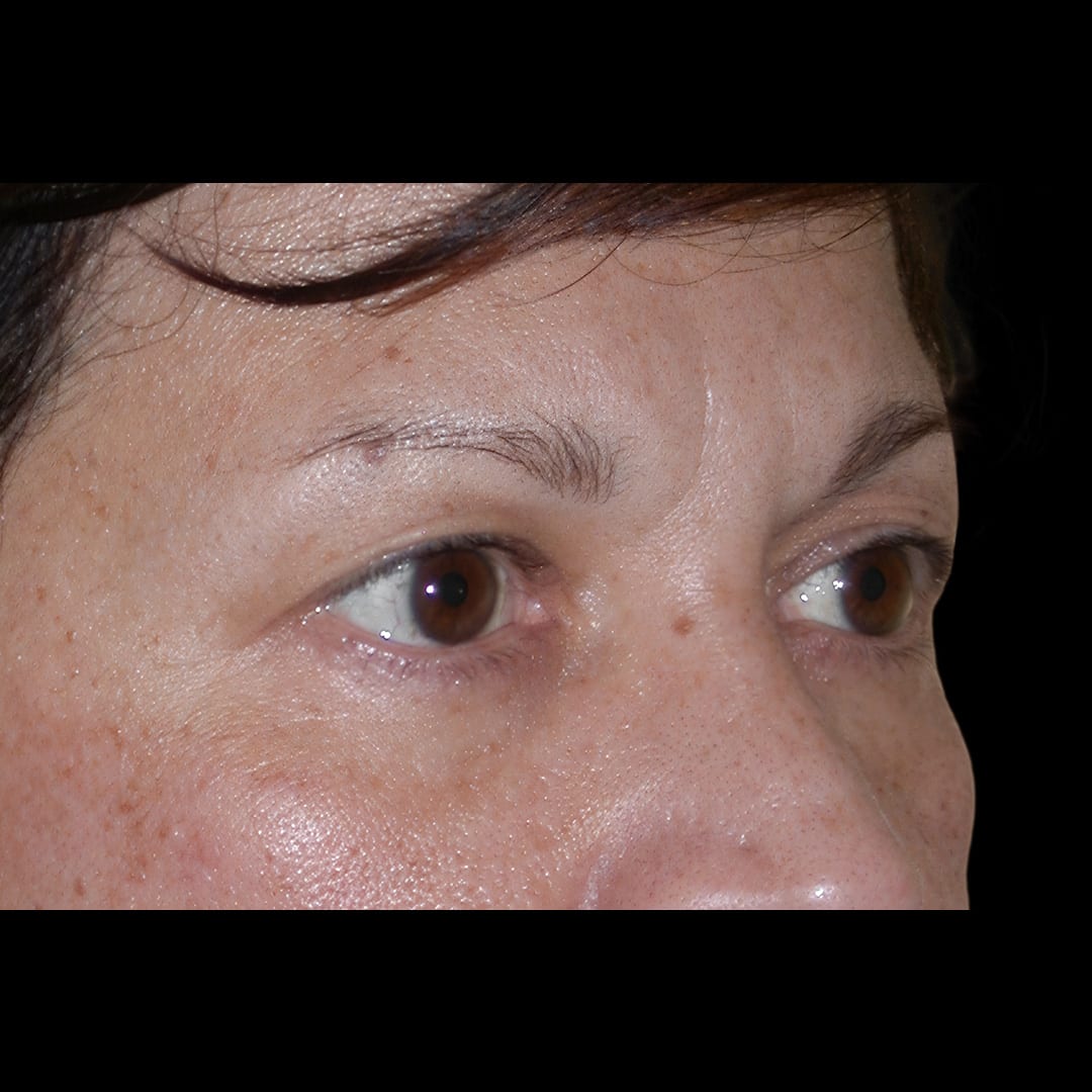Blepharoplasty Before, Female 61 - 4883