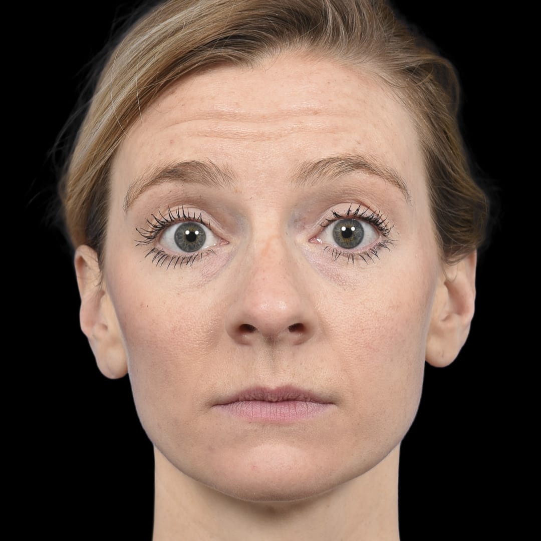 Botox Before, Female 29 - 4893