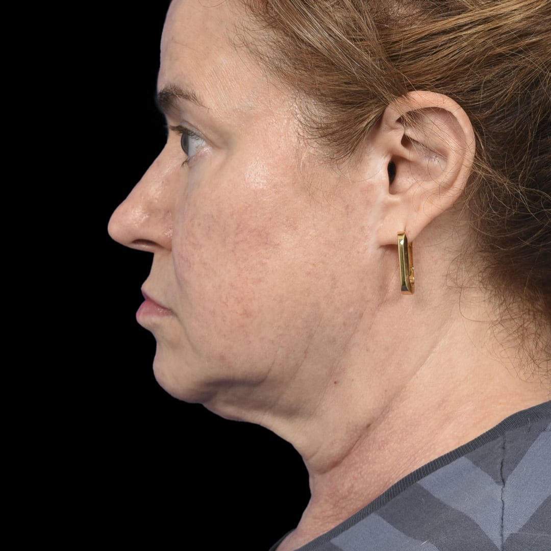 Facelift Before, undefined undefined - 4896