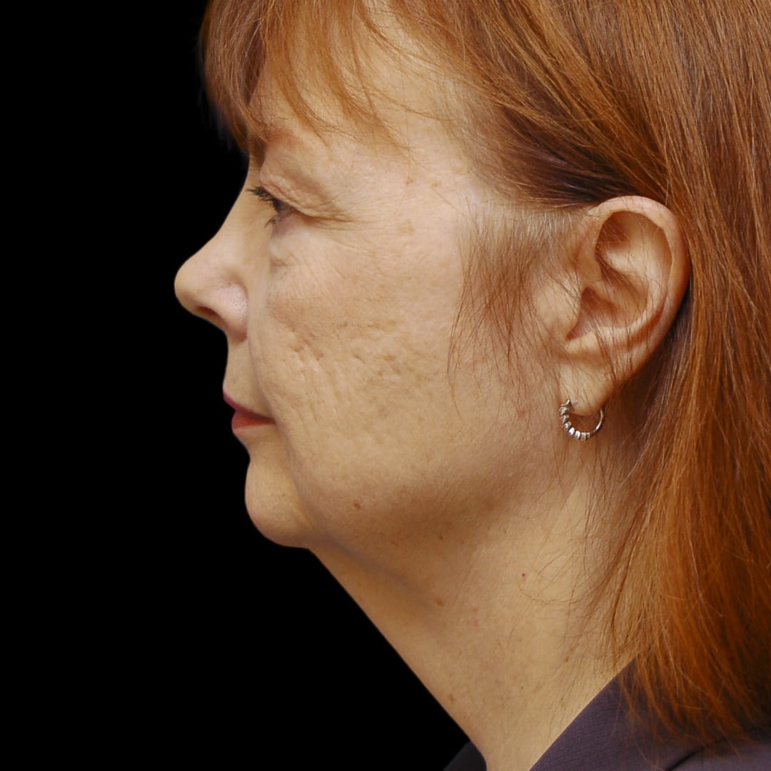 Neck Lift Before, undefined undefined - 4901