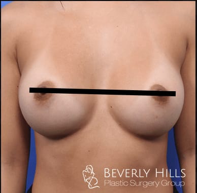 Breast Augmentation (Augmentation Mammaplasty) After, Female 29 - 418