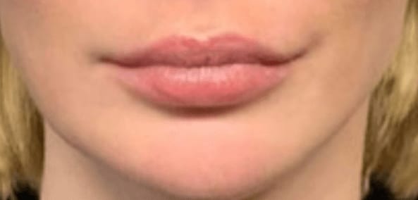 Dermal Fillers & Injectables Before, Female 25 - 1032