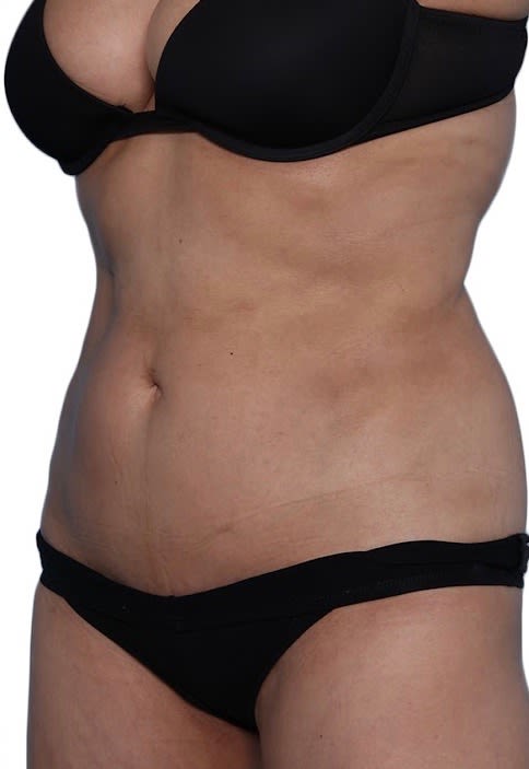 Scar Solutions After, Female 38 - 2303