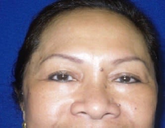 Blepharoplasty After, Female 56 - 1770