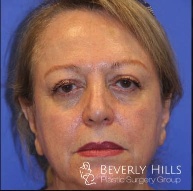 Blepharoplasty After, Female 63 - 411