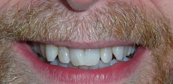 Clear Aligners Before, Male 35 - 1725