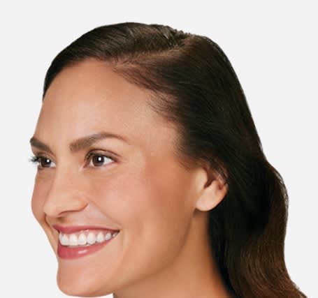 Botox After, Female 35 - 4856