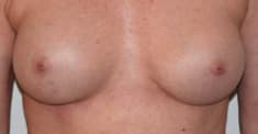 Breast Implant Removal After, Female 57 - 264