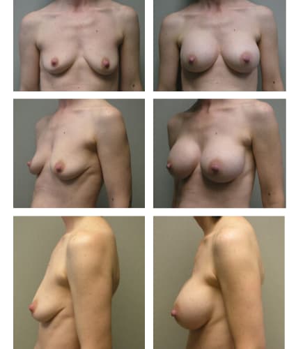 Breast Augmentation with Implants After, Female 28 - 3211
