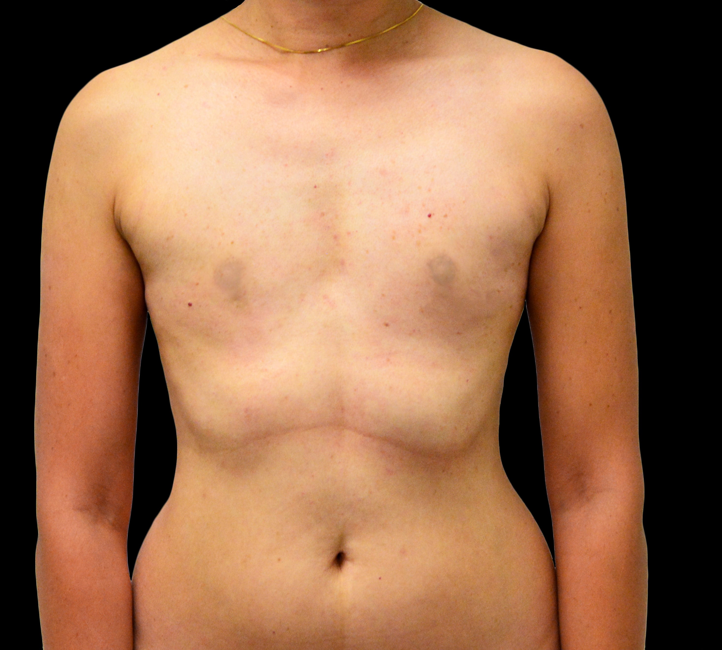 Breast Augmentation with Fat Transfer Before, Female 35 - 918