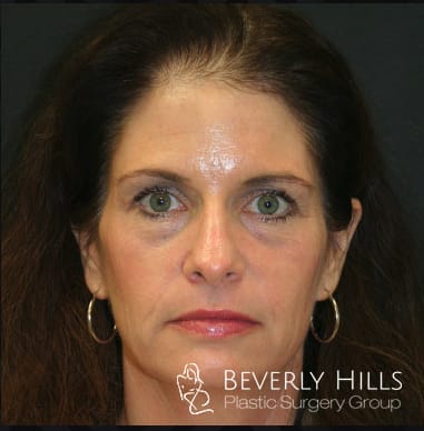Brow Lift Before, Female 54 - 408