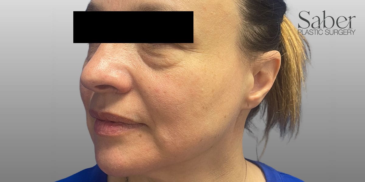Blepharoplasty Before, Female 50 - 3918