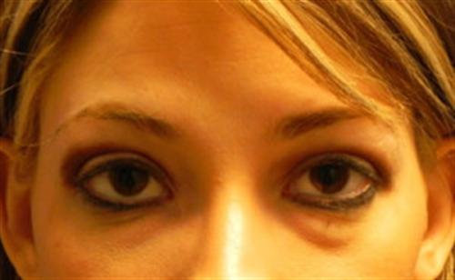 Blepharoplasty Before, Female 32 - 1300