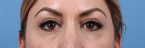 Botox After, Female 34 - 1306