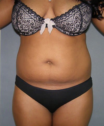 Liposuction Before, Female 34 - 774