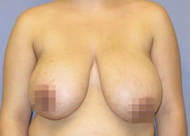 Breast Reduction Before, Female 25 - 3151
