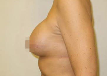 Breast Reduction & Revision Solutions After, Female 51 - 3360