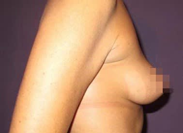 Breast Reduction & Revision Solutions Before, Female 51 - 3361
