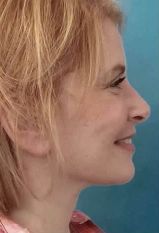 Rhinoplasty After, Female 41 - 2095