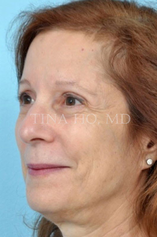 Blepharoplasty After, Female 65 - 3117