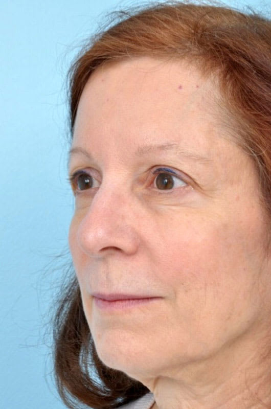 Blepharoplasty Before, Female 65 - 3117