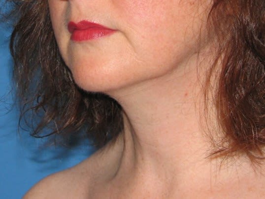 Laser-Assisted Liposuction After, Female 40 - 2981