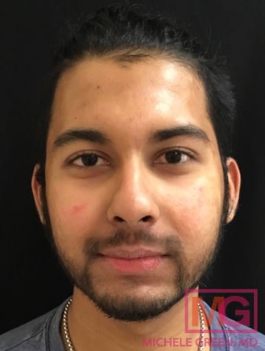 Accutane After, Male 23 - 2959