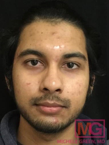 Accutane Before, Male 23 - 2959